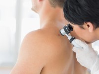 melanoma
