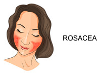 rosacea